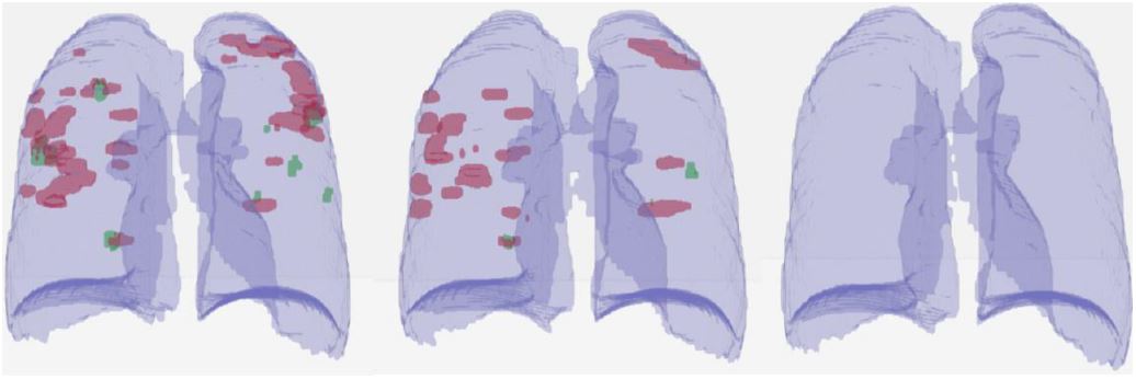 Lung Segmentation